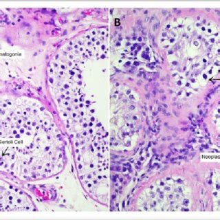 Histologic Features Of Seminoma This Photomicrograph Shows Nests Of