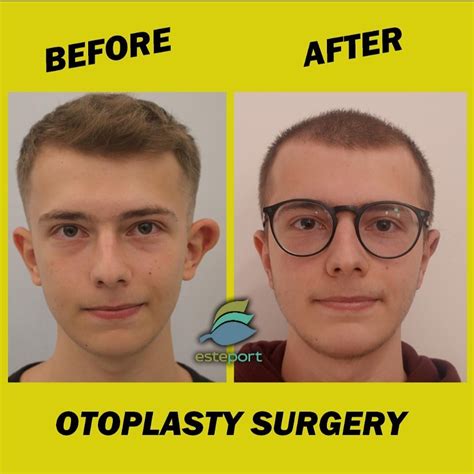 Otoplasty Turkey Price 2024 Ear Pinning Dr Ali Mezdeği