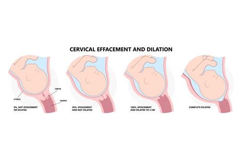 Cervix Dilation Chart Signs Stages And Procedure To Check Cervix