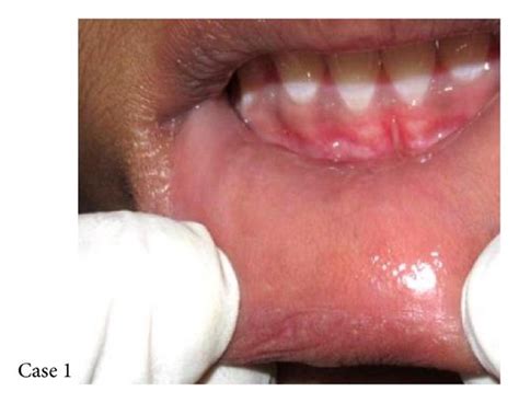 Case Showing Mucocele In Right Lower Labial Mucosa Measuring Mm