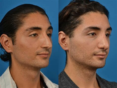 Patient 122406391 | Male Rhinoplasty Before & After Photos | Clevens ...