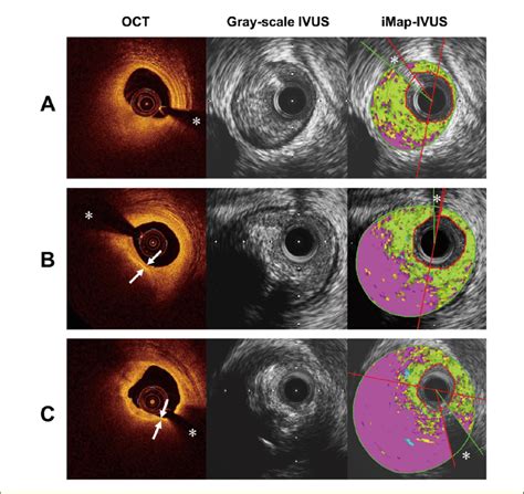 Representative Optical Coherence Tomography Oct Gray Scale And