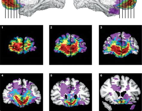 Deric's MindBlog: Damage to the prefrontal cortex increases utilitarian moral judgements