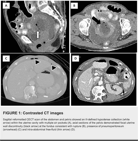 Figure From Computed Tomography Findings In A Case Of Uterine Rupture