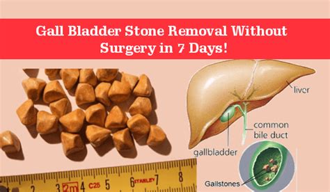 Are You Wondering How To Dissolve Gallstones Naturally Dont Worry Now