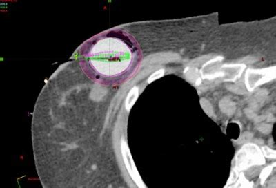 Accelerated Partial Breast Irradiation Central Florida Cancer Care Center