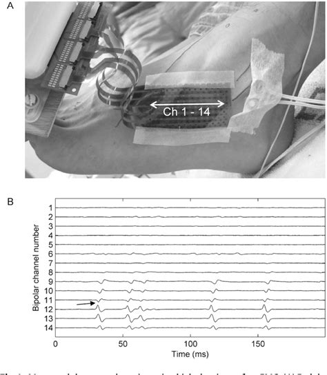 Figure 1 From Botulinum Toxin Has An Increased Effect When Targeted