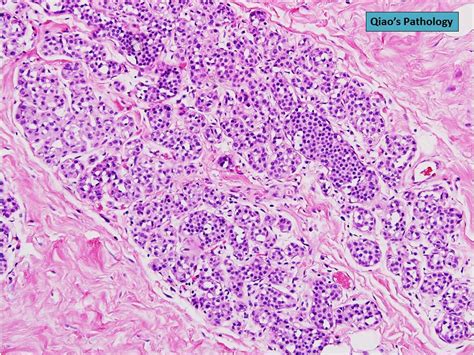 Qiao S Pathology Rosen Triad A Photo On Flickriver