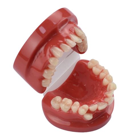 3D Resin Dental Model Teeth Malocclusion Model For Demostration