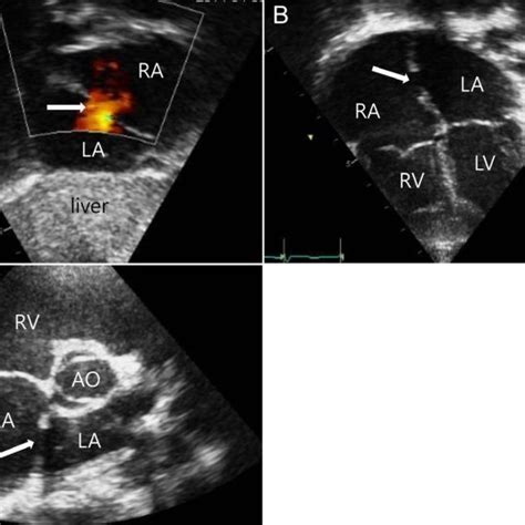 Transthoracic Echocardiography Tte Images Of An Atrial Septal Defect