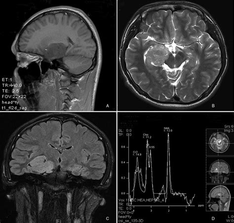 Magnetic Resonance Imaging Mri Of The Brain Indicated A Download