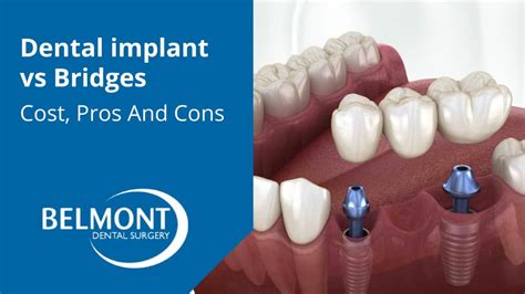 Dental Bridge Cost