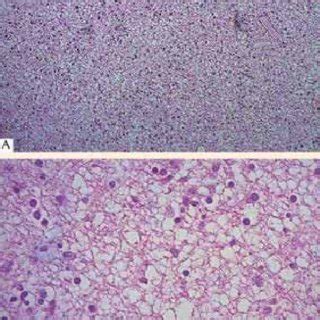 Microfotografías de inmunohistoquímica que muestran células reactivas a