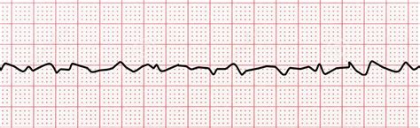 Differentiating Ventricular Tachycardia and Ventricular Fibrillation On ...