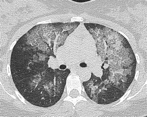 CBR Bradcases PNEUMONIA POR COVID 19 ACHADOS TOMOGRÁFICOS DE