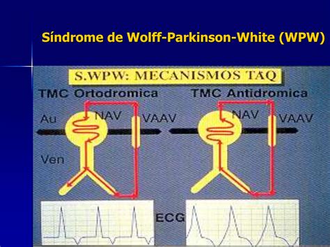 Síndrome De Wolff Parkinson White Wpwppt