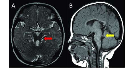 The Brain Mri Of The Patient At 6 Months Of Age Molar Tooth Sign