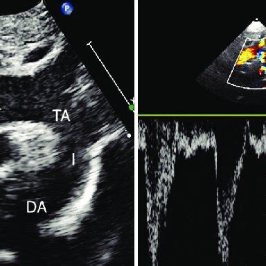 Suprasternal Long Axis View Of The Arch A With Spectral Doppler B