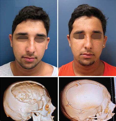 SciELO Brasil Cranioplastias estratégias cirúrgicas de