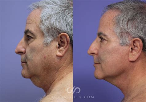 Neck Lift Traceless Neck Lift Before And After Pictures Case