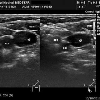 The Right Common Carotid Artery A Longitudinal View B Transverse