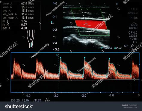 Color Doppler Ultrasound Imaging Normal Common Stock Photo 1341123389 ...