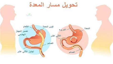 تعرف على مميزات عملية تحويل مسار المعدة