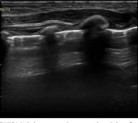 [pdf] Acute Respiratory Distress Syndrome Or Pneumonia The Role Of Lung Ultrasound Semantic