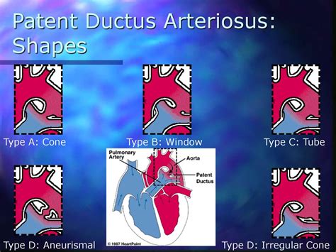 Patent Ductus Arteriosus Occlusion Device Ppt Download