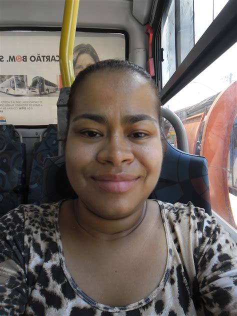 Antes E Depois Ortognatica 2