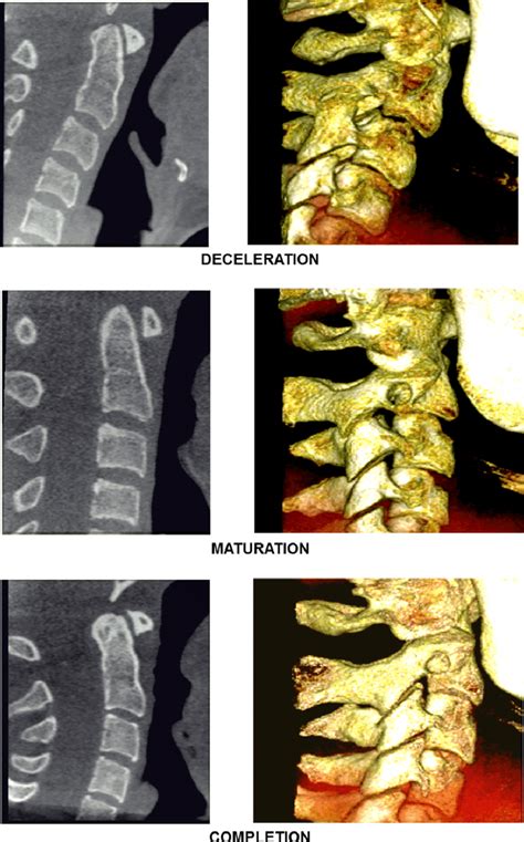 Cervical Vertebrae Maturation Stages On CBCT Sagittal Slices Left And