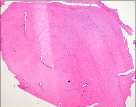 Figure 4 from Gardner Syndrome Showing Multiple Osteomas in the Jaws | Semantic Scholar