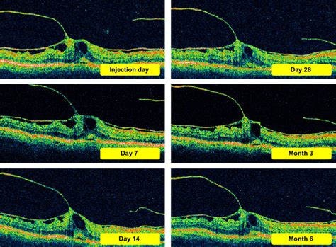 examples of OcT images of a patient with strong epiretinal membrane and... | Download Scientific ...