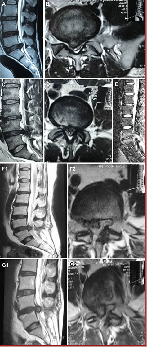 Lumbar Disc Herniation MRI