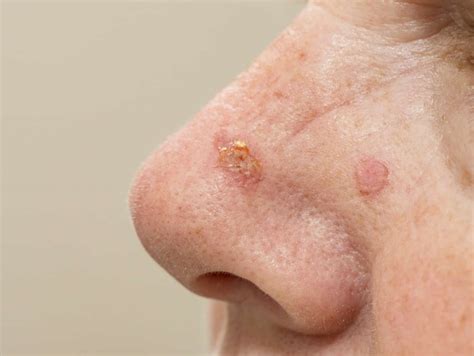 Premalignant Epidermal Lesions Stamford Skin Centre