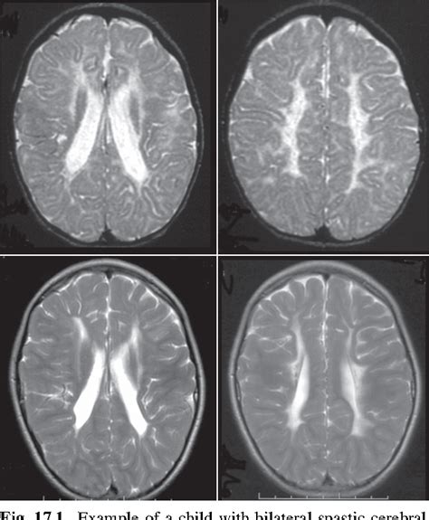 Cerebral Palsy Brain