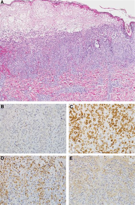 Histology and immunohistochemistry of a representative skin lesion ...