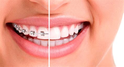 Tipos De Brackets Para Ortodoncia Premium Dental