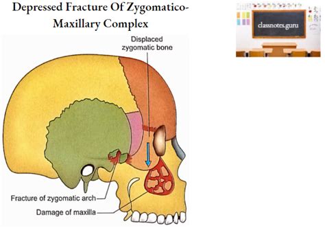 Zygomatic Bones Osteology Notes Class Notes