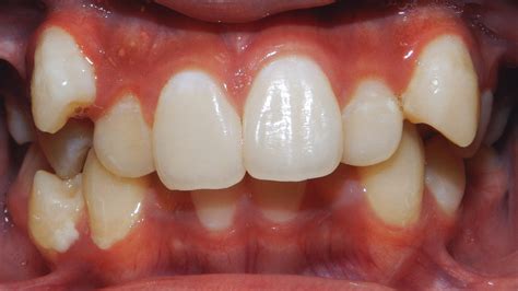 Class Ii Malocclusion Excessive Overjet Deep Overbite Severe Dental Crowding Case Gallery