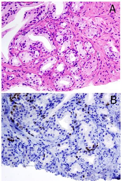 Atypical Adenomatous Hyperplasia Aah A Small Glands Forming A Download Scientific Diagram