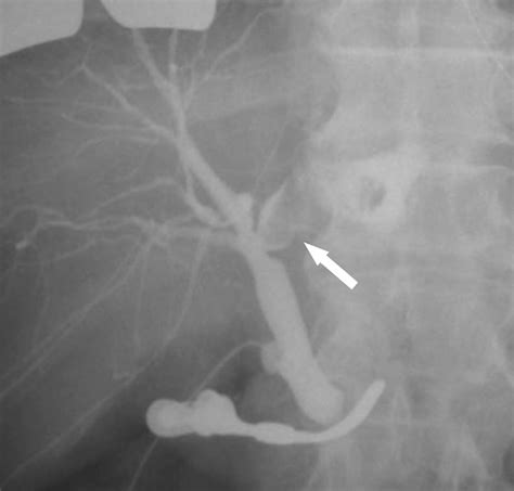 Intraoperative Cholangiography Revealed A Crab Claw Like Filling Defect