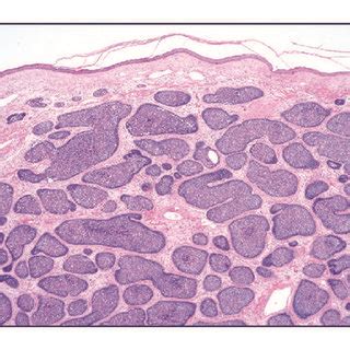 Histopathologic Findings A Low Magnification Of Skin Surface Showing