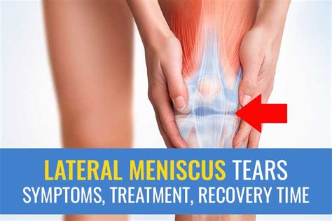 Lateral meniscus tears: Symptoms, treatment (surgery vs. exercise), and ... 
