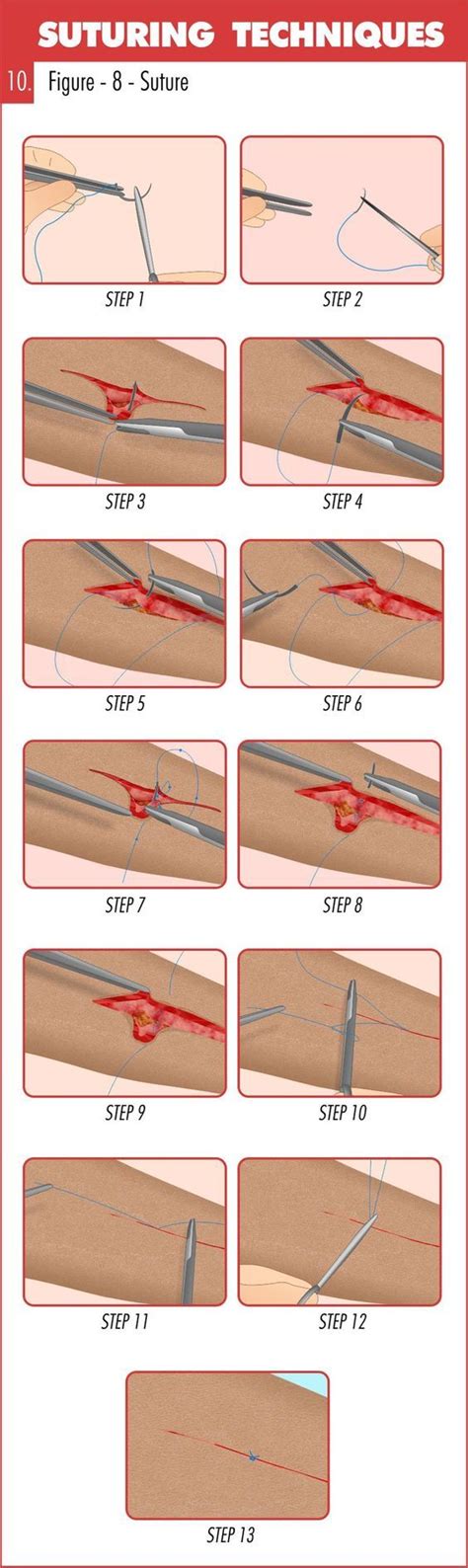 Complete Guide To Mastering Suturing Techniques Just In Case