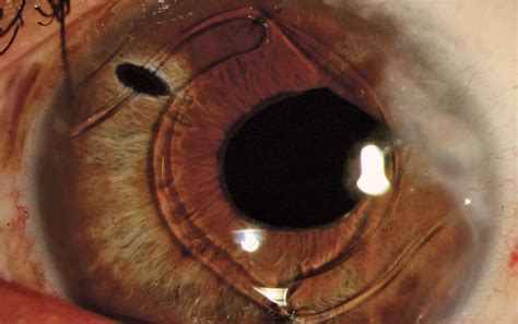 Figure From Iris Fixation Of Unstable Anterior Chamber Intraocular