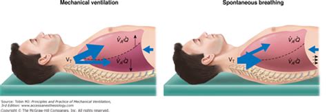 Airway Pressure Release Ventilation Anesthesia Key