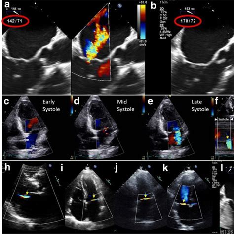 Grading Of Mitral Regurgitation Severity VCW Vena Contracta Width