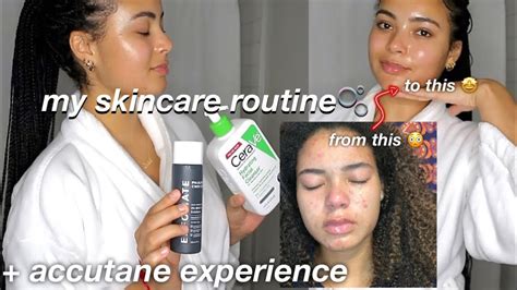 My Skincare Routine My Accutane Experience Before And After Pics