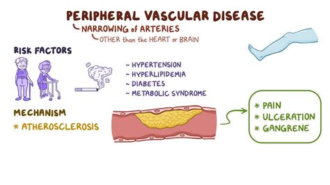 Peripheral Vascular Disease Clinical Osmosis Video Library